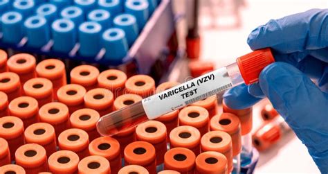 varicella blood test bottle|Laboratory Testing for Varicella.